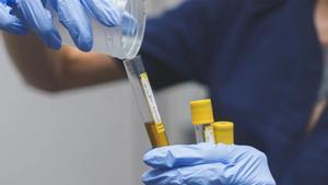 Muestras de orina para para practicar un análisis.