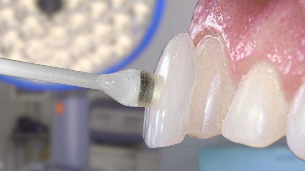 Carillas dentales minimamente invasivas en Tenerife