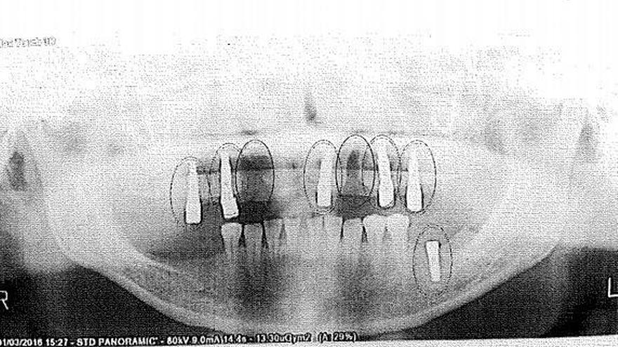 Inhabilitadas dos odontólogas de Zaragoza por cinco implantes mal puestos