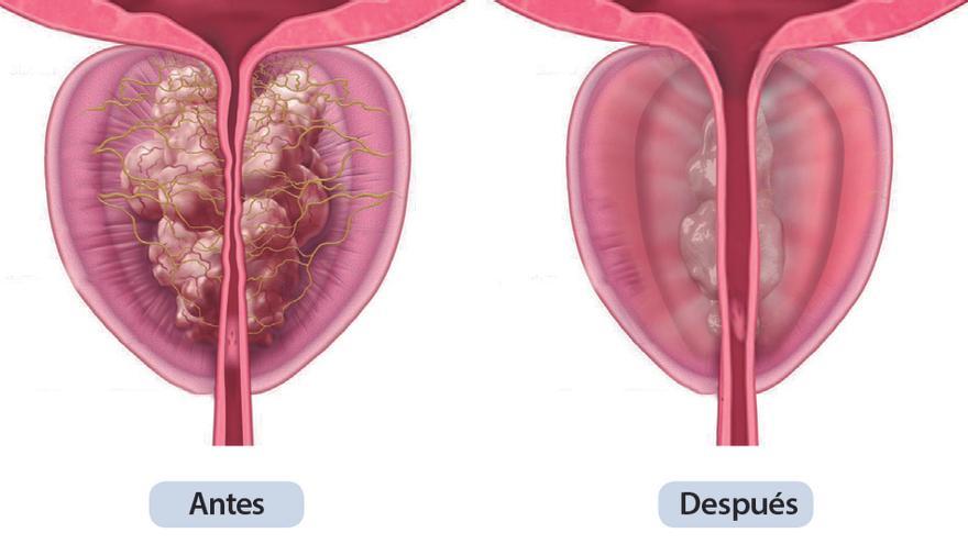 Antes y después de la próstata con el tratamiento.