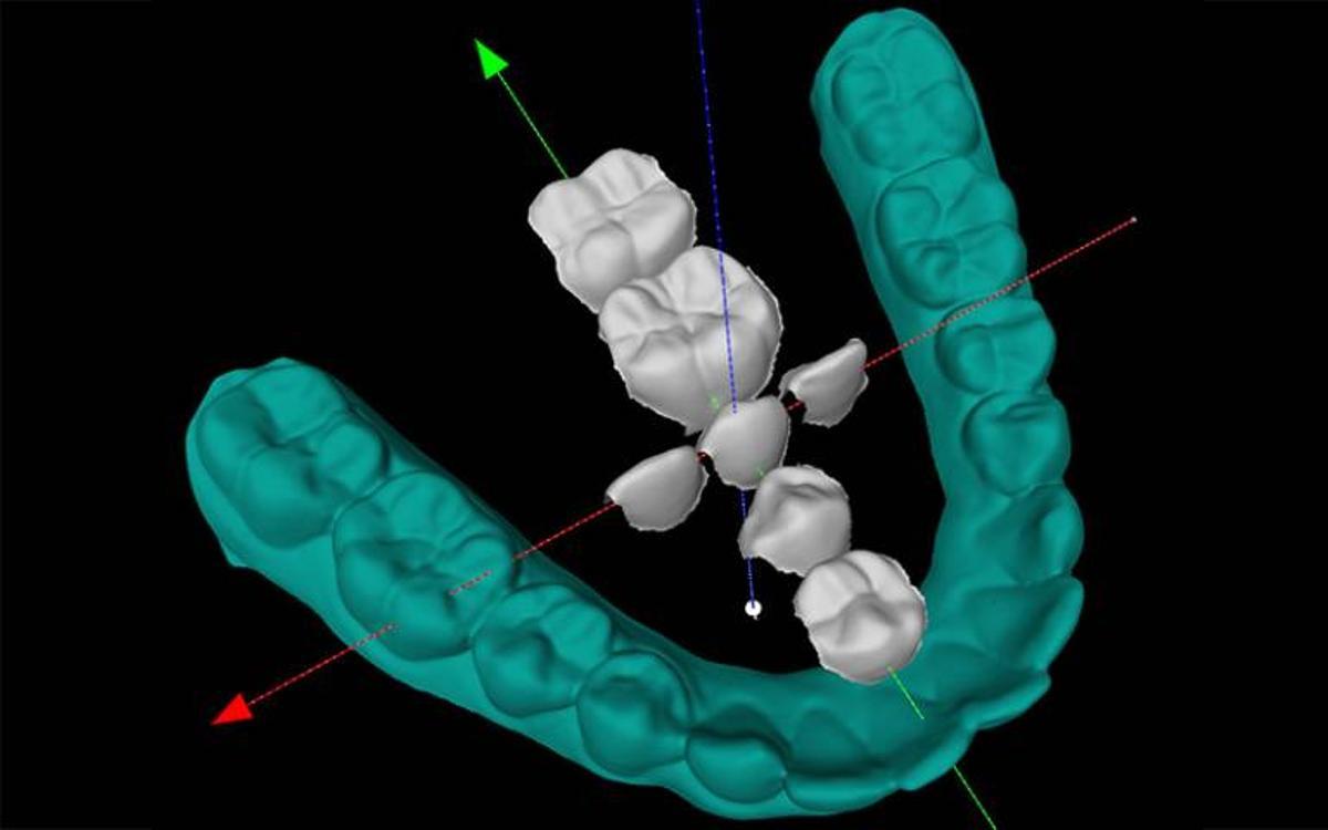 Ejemplo de escáneres dentales utilizados para medir las dimensiones de los dientes, que muestra su disposición en la mandíbula inferior.