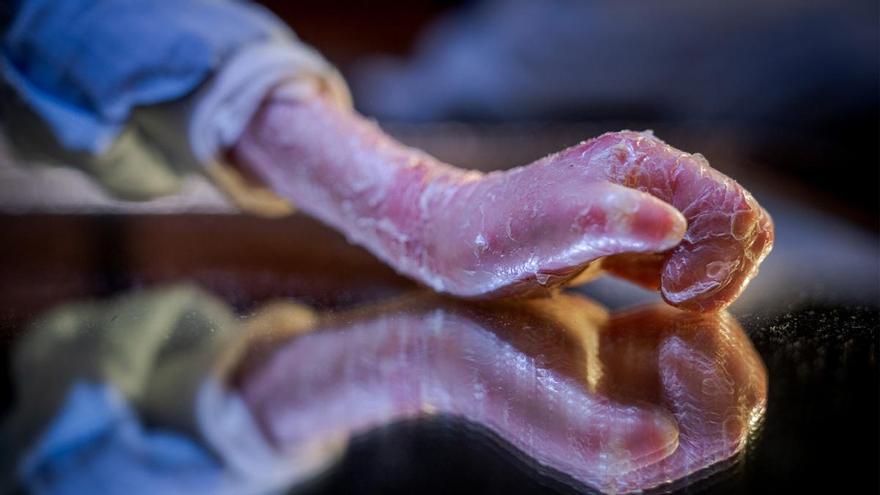 Aprueban un medicamento pionero contra la Piel de Mariposa