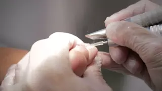 Esta es la enfermedad que puede hacer que te quedes sin uñas en las manos y los pies
