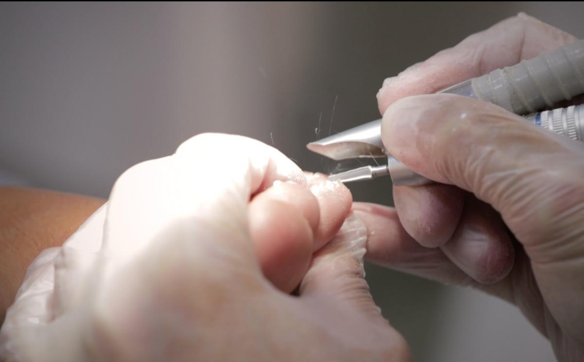 Anoniquia, la enfermedad rara de la ausiencia de uñas en los pies