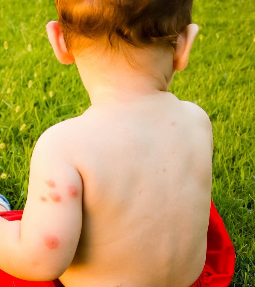 ¿Cómo proteger a los bebés de las picaduras de los mosquitos?