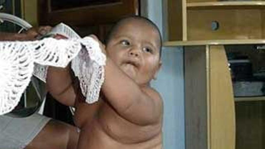 Los médicos brasileños investigan el caso de un bebé que pesa 25 kilos