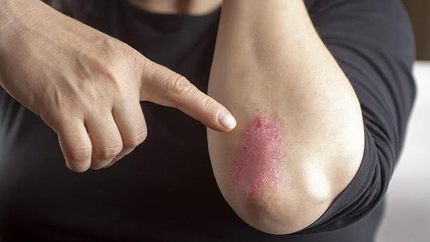 Un caso de psoriasis.