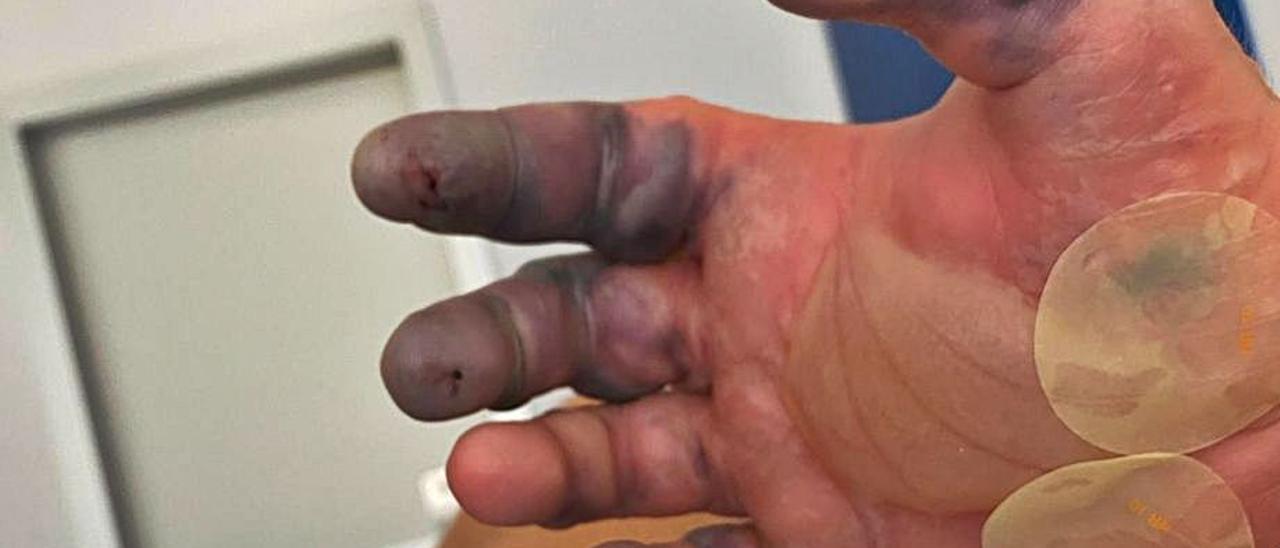 El joven ha perdido dos dedos por la picadura de una araña en Ibiza
