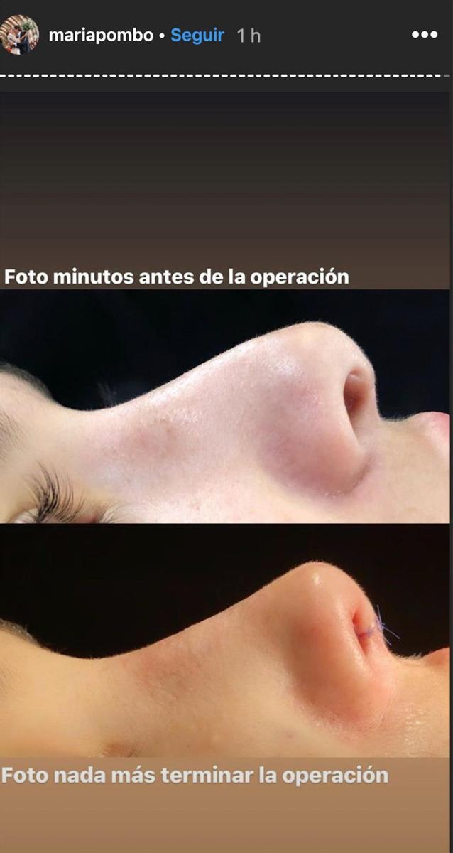 María Pombo y su operación de nariz