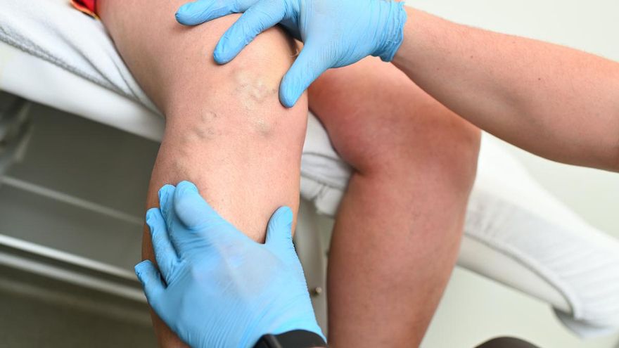 Cómo eliminar las varices sin cirugía: loo que necesitas saber