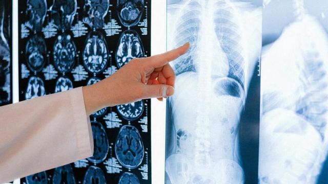 Un metge observa una radiografia de pulmó.