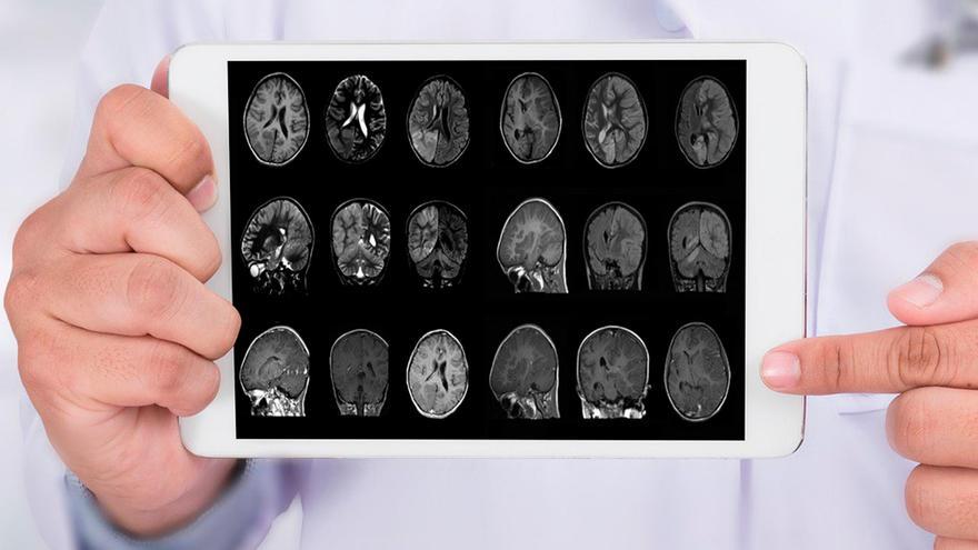 Un nuevo estudio sobre el Alzheimer revela su causa, distinta de la que se pensaba