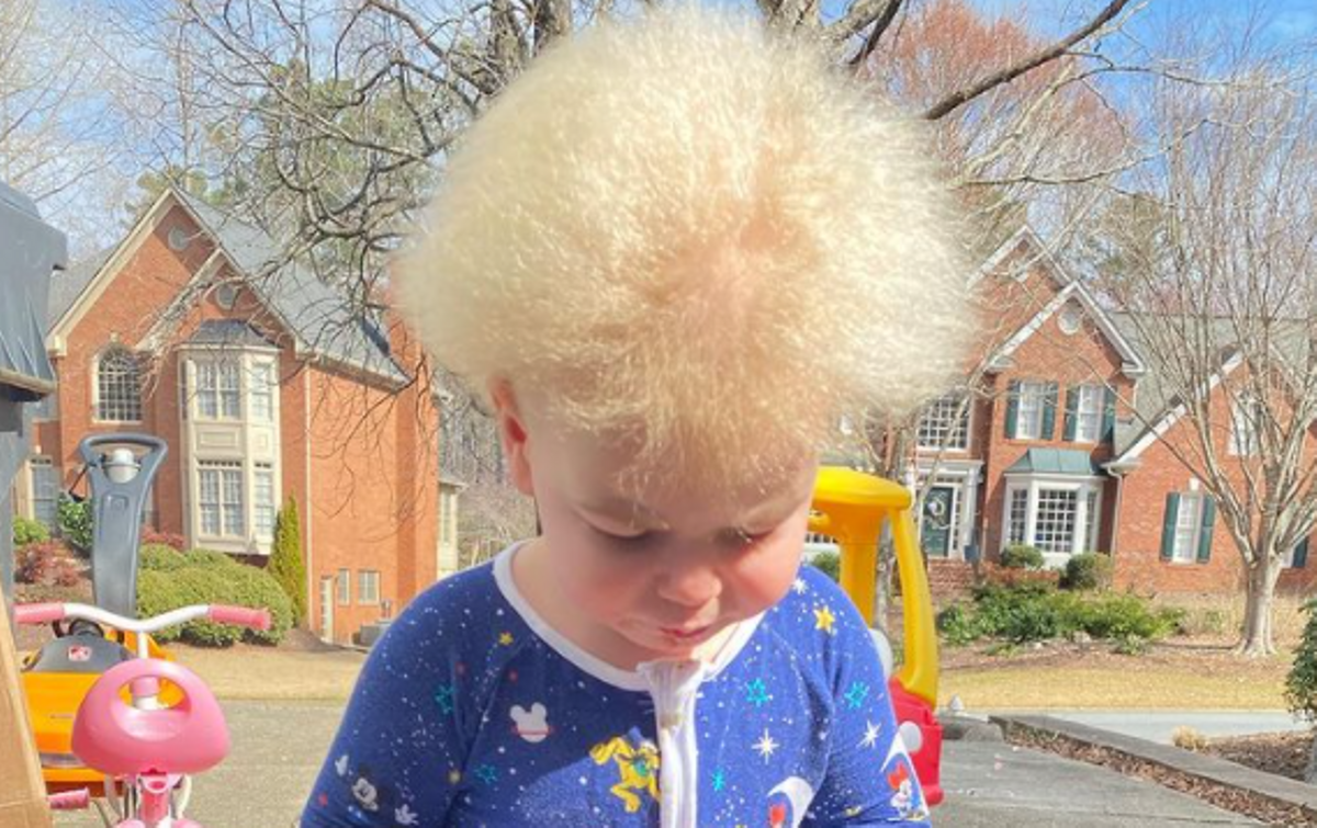 Els cabells d’un nen d’Instagram donen a conèixer la ‘síndrome dels cabells que no es poden pentinar’