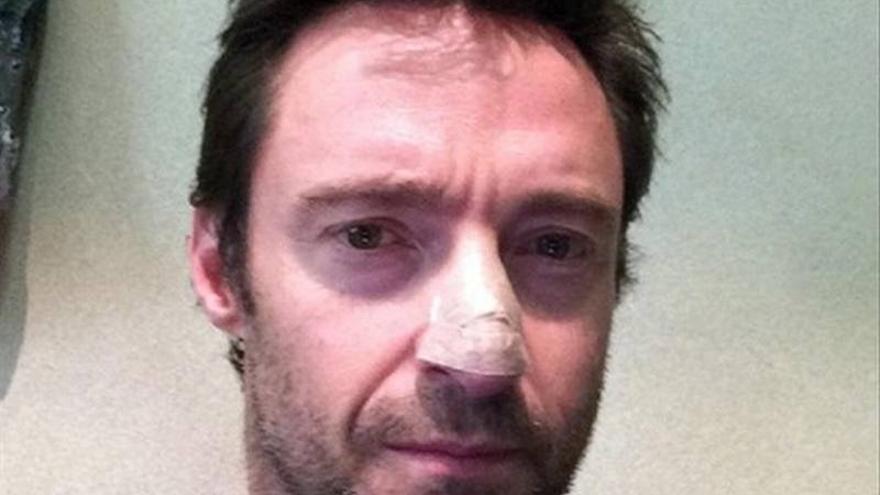 Hugh Jackman es tratado del segundo carcinoma en la nariz