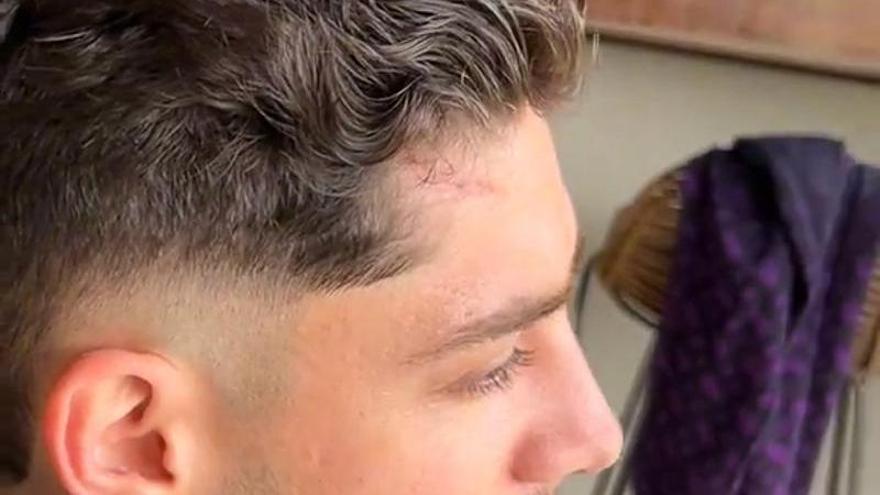 Enseñan las cicatrices de Fede Valverde tras su pelea con Tchouaméni