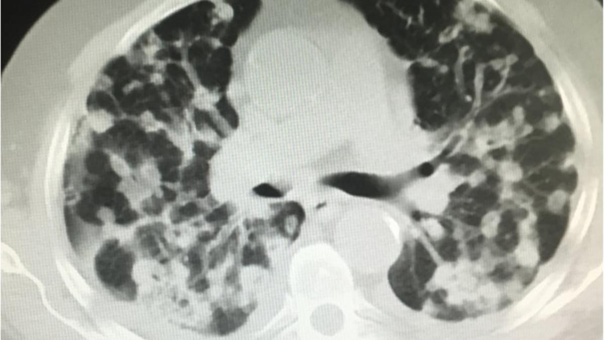 El cáncer de pulmón es una de las principales causas de muerte en el mundo