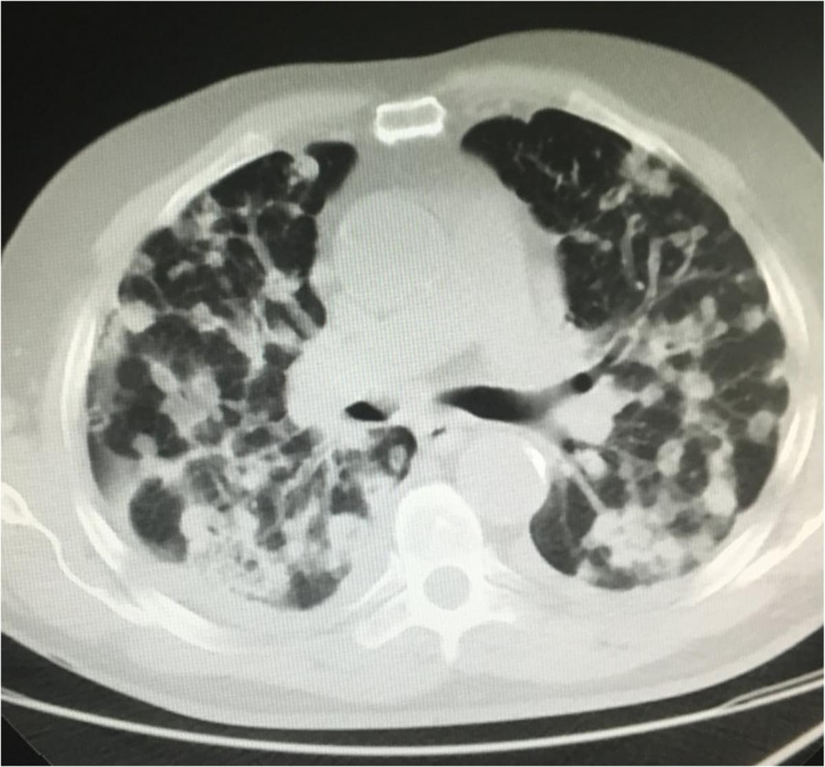 cancer-pulmon