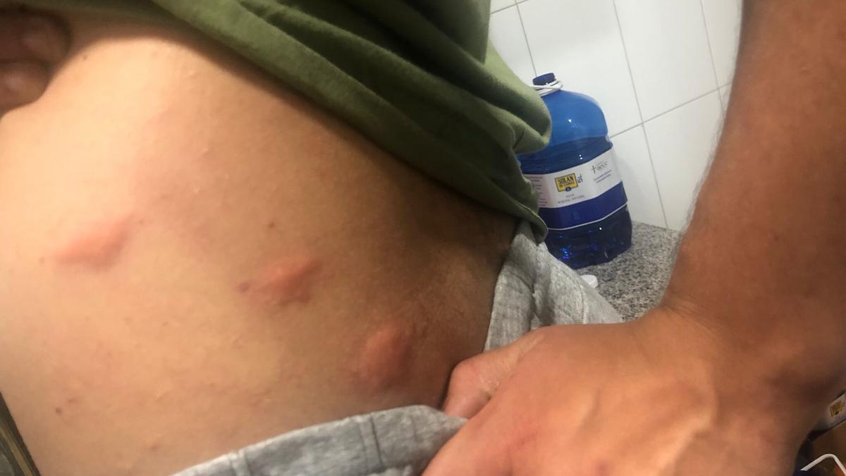 Un joven muestra las picaduras que le han causado, estos días, los mosquitos.