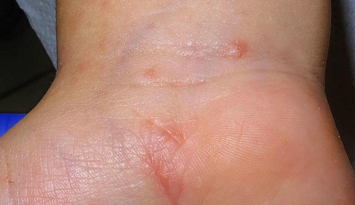 Paciente con lesiones de sarna en muñeca y mano.