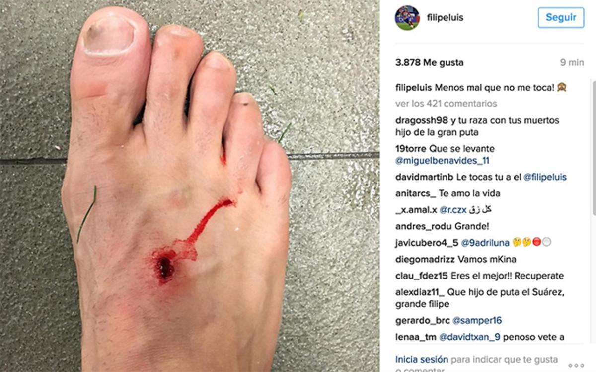 Así quedó el pie de Filipe Luis