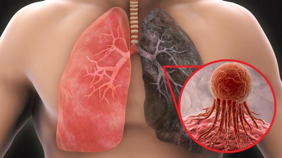 El cáncer de pulmón, primera causa de muerte.