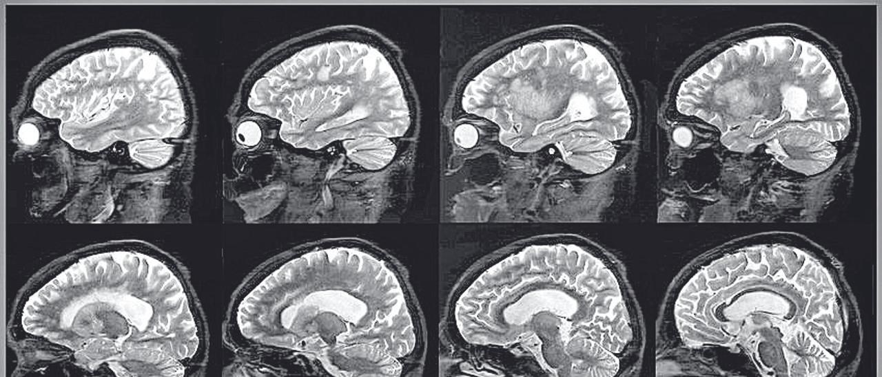 Una serie de placas muestra la evolución del cerebro de un enfermo de alzhéimer.