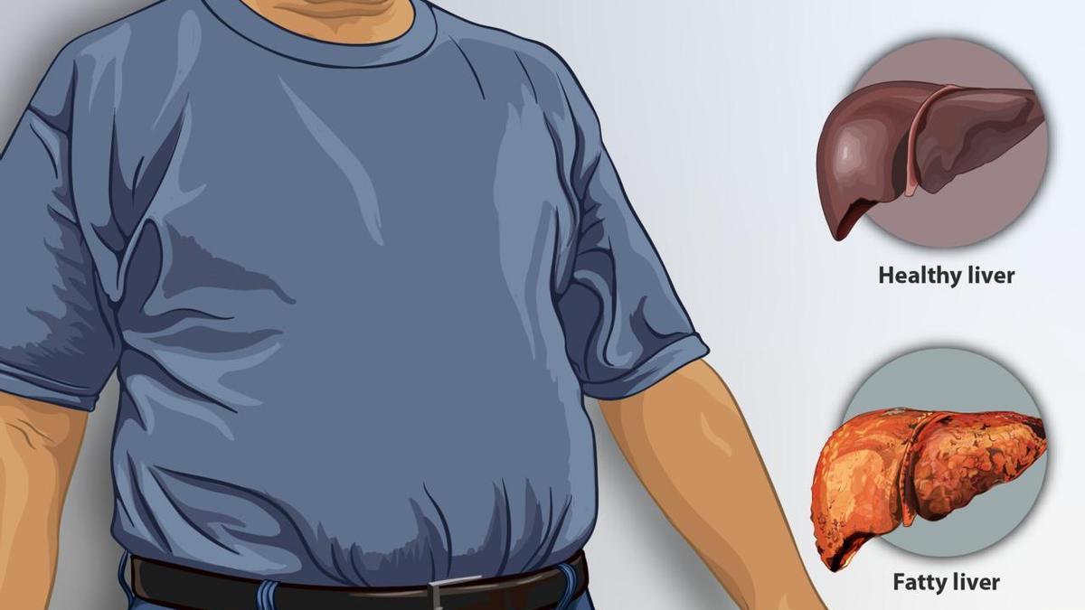 Esta es una representación de un hombre que sufre de hígado graso en comparación con un hígado sano.