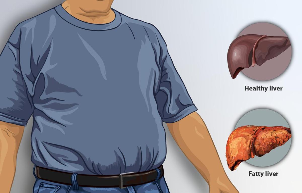 Esta es una representación de un hombre que sufre de hígado graso en comparación con un hígado sano.