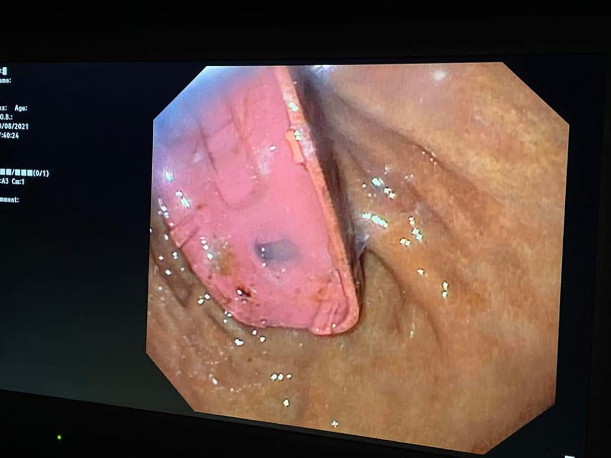 Una imagen del teléfono móvil dentro del estómago del paciente