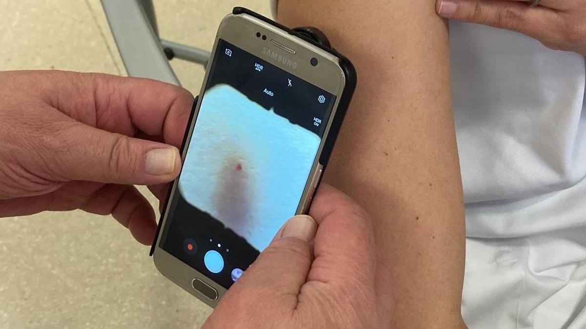Una fotografia del mòbil amb el dermatoscop incorporat que fan servir els metges de primària per efectuar imatges de les lesions cutànies dels pacients