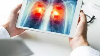 Combinar inmunoterapia y radioterapia es eficaz en cáncer pulmonar con metástasis cerebral