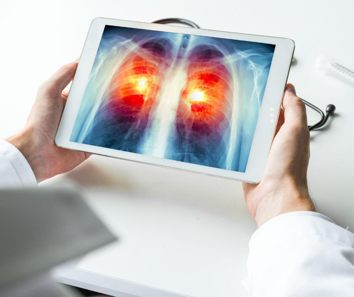 Combinar immunoteràpia i radioteràpia és eficaç en càncer pulmonar amb metàstasi cerebral Combinar immunoteràpia i radioteràpia és eficaç en càncer pulmonar amb metàstasi cerebral