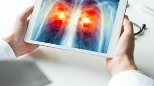 Combinar immunoteràpia i radioteràpia és eficaç en càncer pulmonar amb metàstasi cerebral