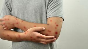 Persona infectada por sarampión.