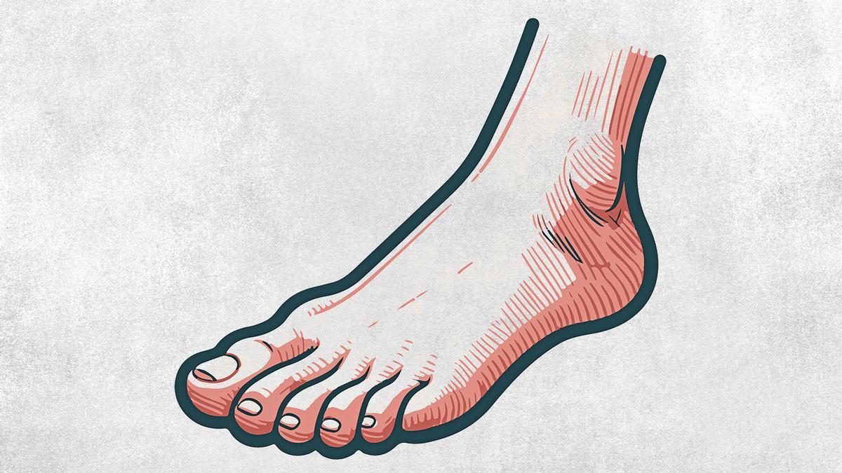 Juanete, ese inquilino molesto (y doloroso) del pie