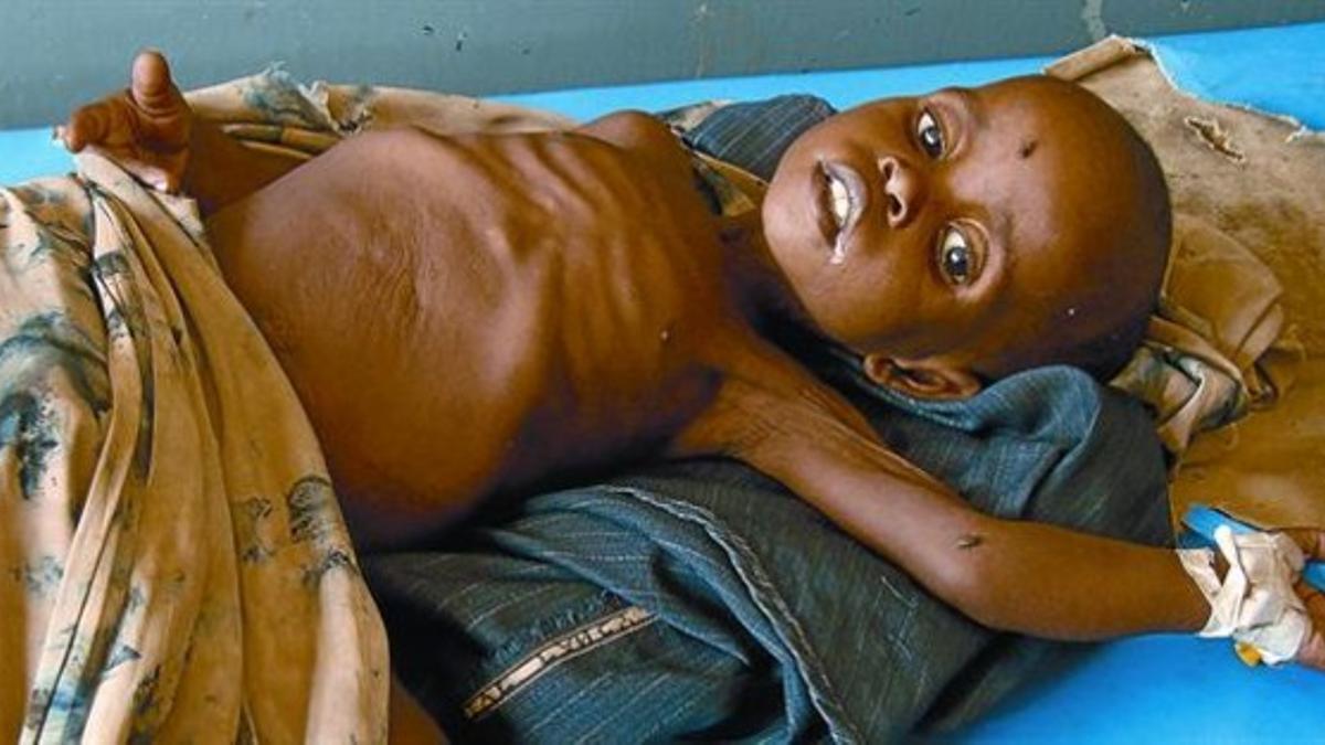 Un niño somalí malnutrido en el hospital Banadir de Mogadischo.