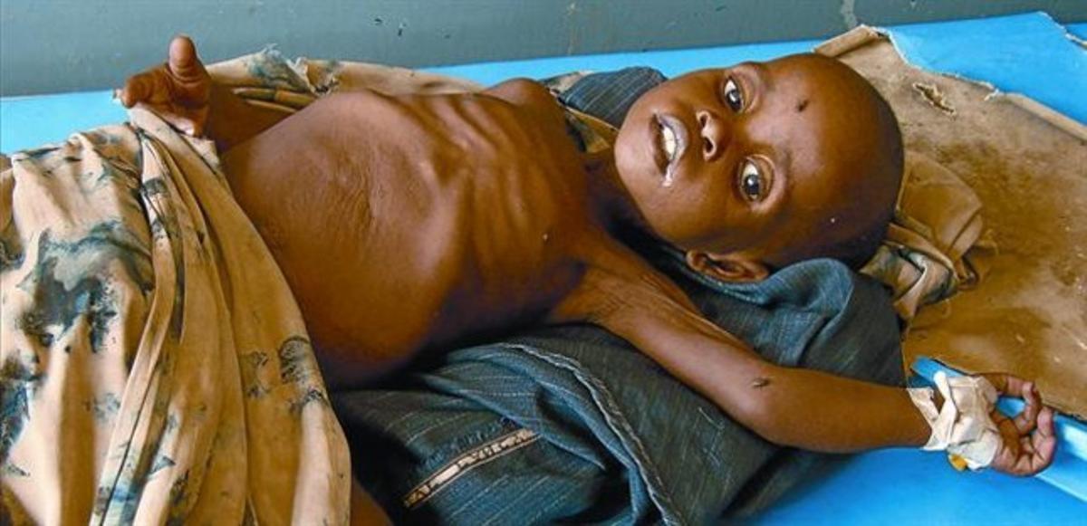 Un nen somali malnodrita l’hospital Banadirde Mogadiscio.