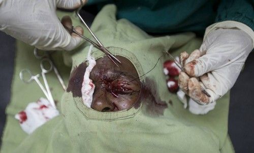 A patient undergoes trichiasis surgery at a health centre, in Cheha district, in the Southern Nations, Nationalities, and Peoples' Region (SNNPR) in Ethiopia