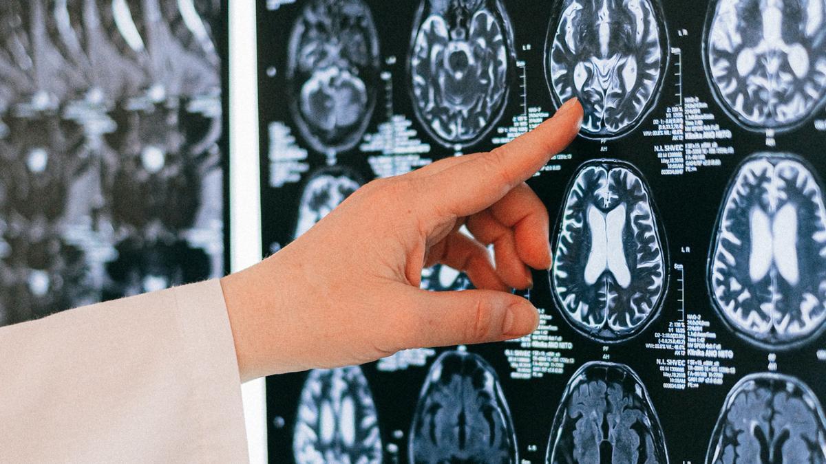 Un nuevo estudio encuentra que &quot;algo cambia en el cerebro de quienes han sufrido COVID-19&quot;