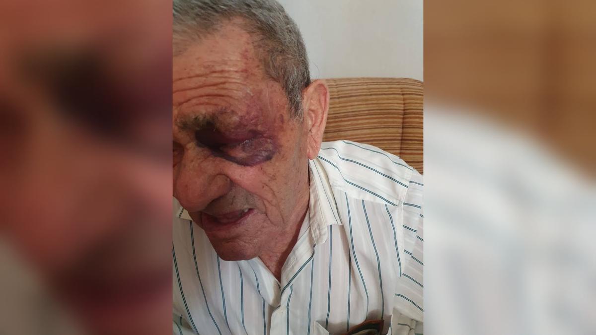 La víctima del asalto violento en Palma del Río, con un fuerte hematoma en el ojo.