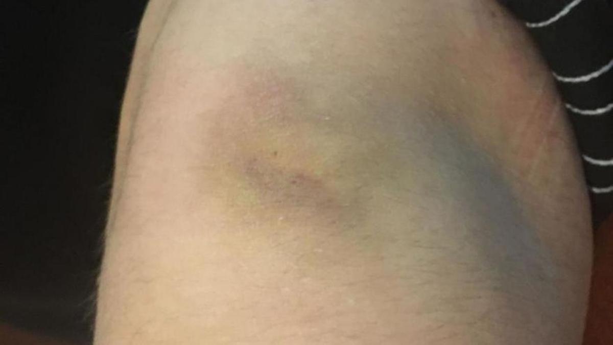 El hematoma en una de las rodillas de la víctima tras ser agredida.