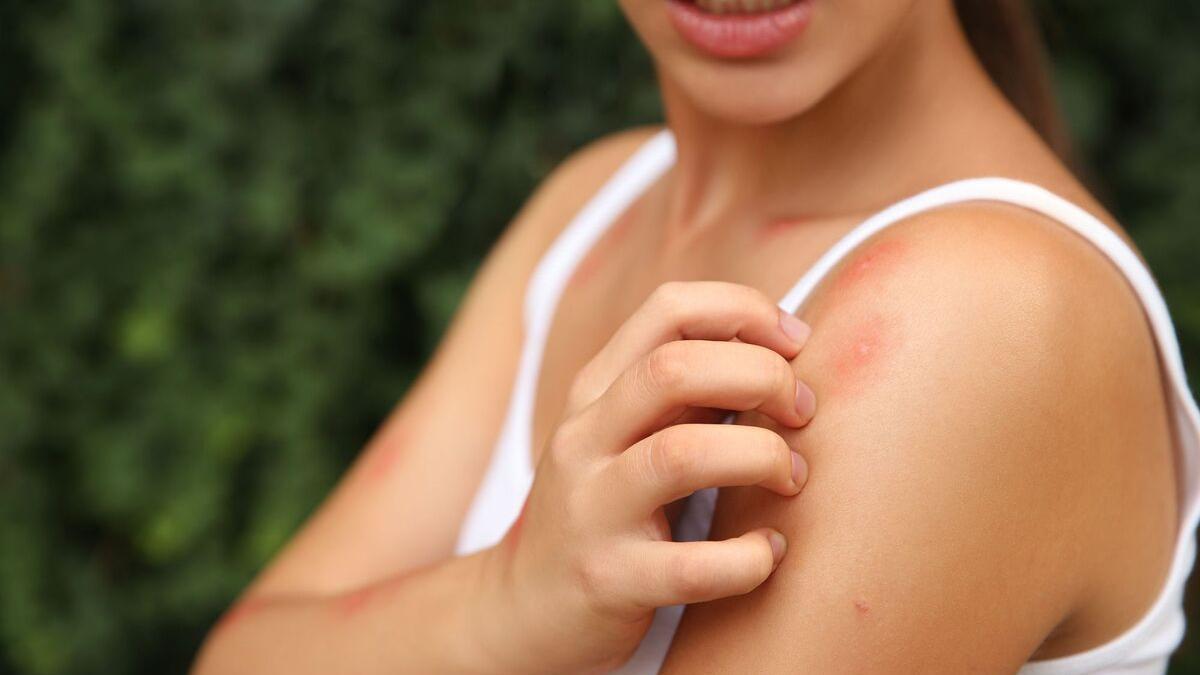 La aparición de ronchas tras una picadura es un suceso habitual en verano.