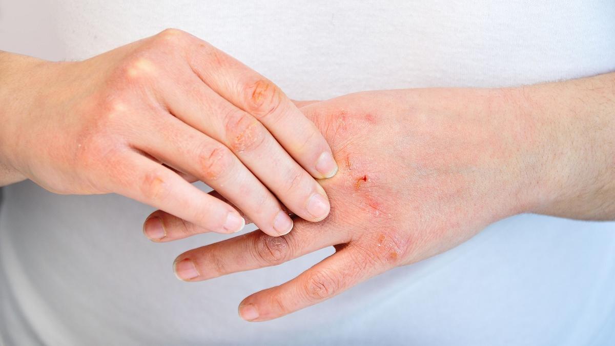 La dermatitis por contacto puede aparecer en cualquier parte del cuerpo