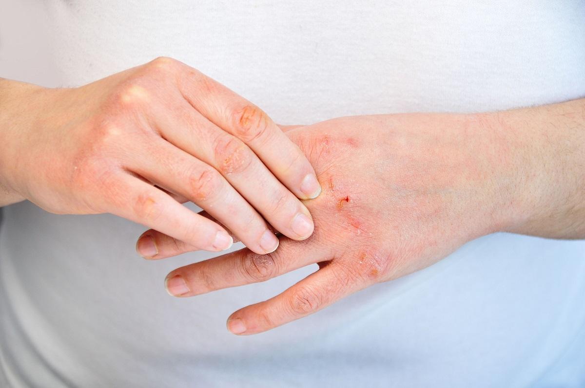 La dermatitis por contacto puede aparecer en cualquier parte del cuerpo