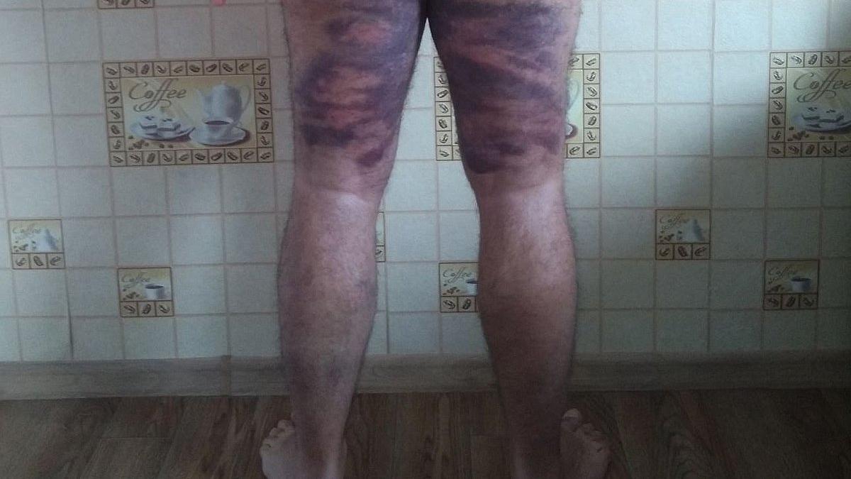 Vladímir, con las piernas cubiertas de moratons por los golpes de la policía bielorrusa.