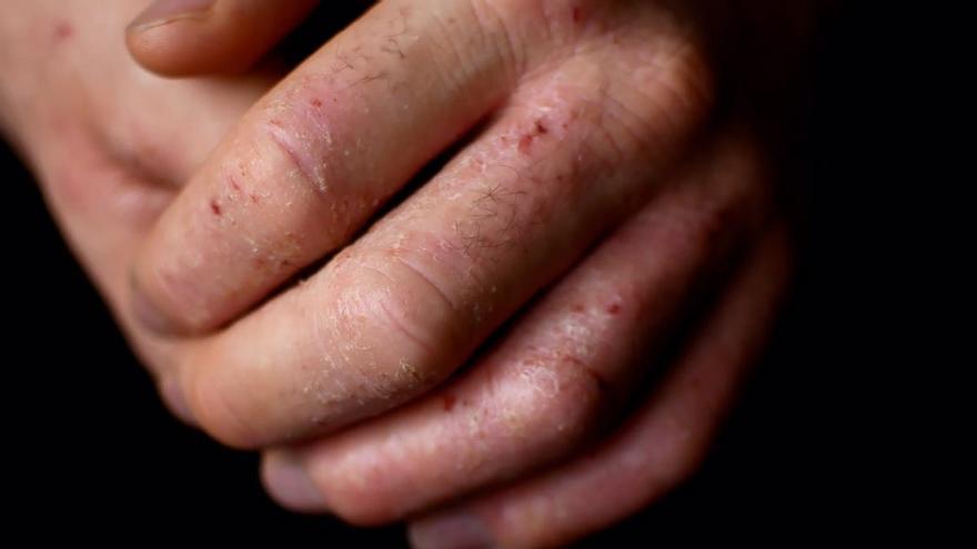 Claves sobre la dermatitis atópica