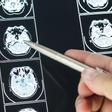 Cómo reconocer los síntomas de la epilepsia, la tercera enfermedad con más casos en mayores de 65 años