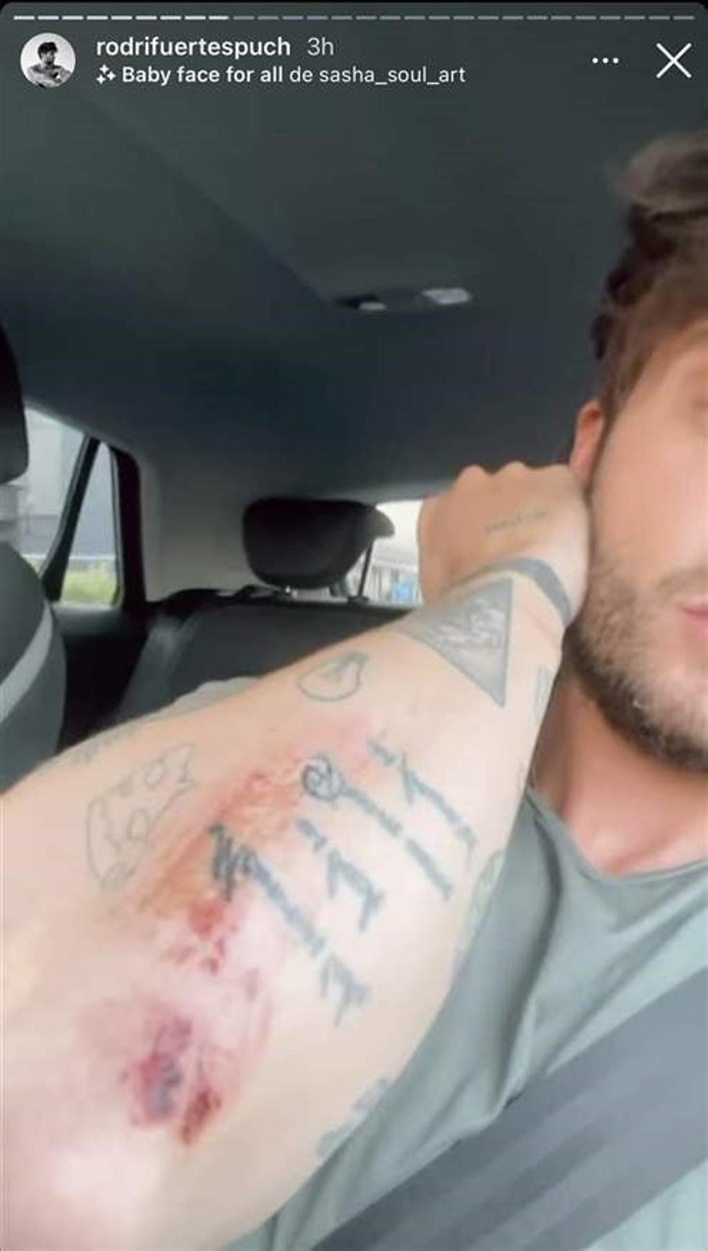 Las heridas de Rodri Fuertes tras su accidente de moto