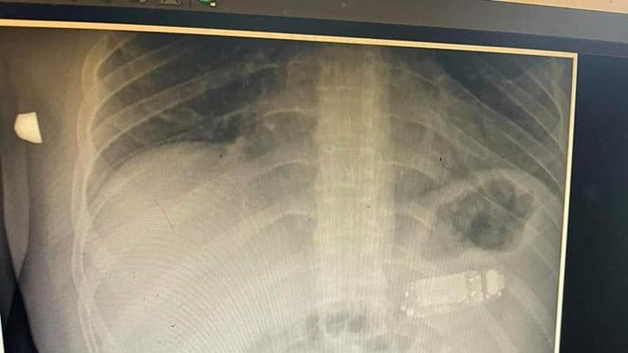 La radiografía donde se aprecia el teléfono dentro del estómago del paciente.