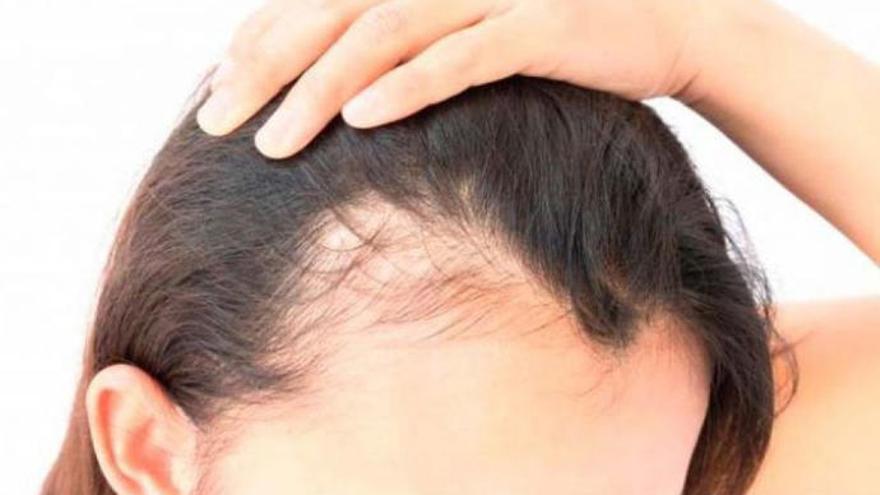 La alopecia femenina afecta a un gran número de mujeres. / Cedida